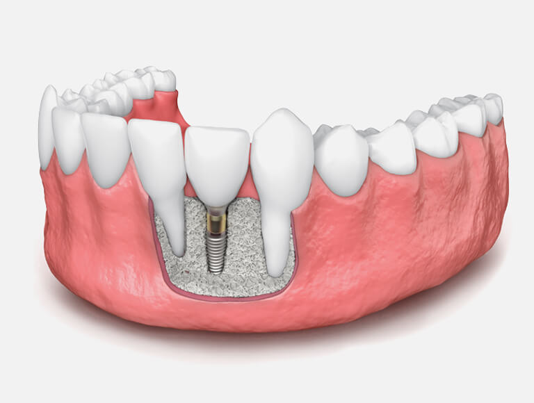 The Role of Bone Grafting in Implants
