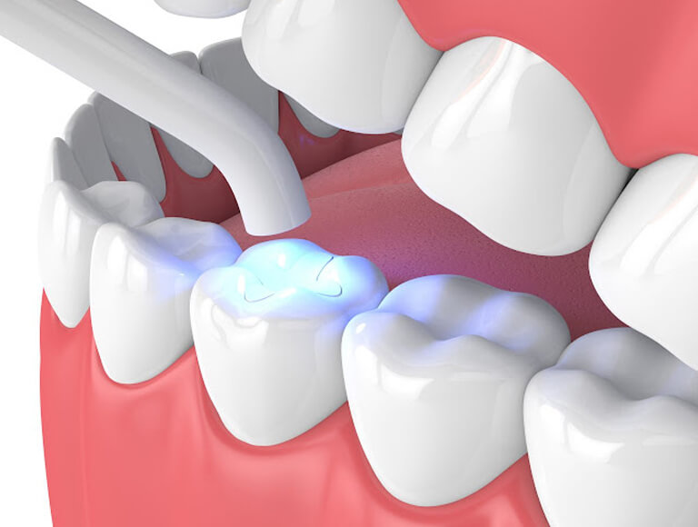 Tooth-colored Composite Fillings