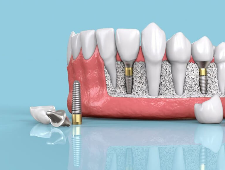 The Value Proposition of Dental Implants