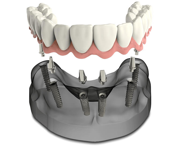 Benefits of Teeth in a Day Dental Implants